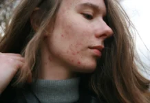 Huidaandoeningen: oorzaken, behandelingen en preventie Huidaandoeningen: oorzaken, behandelingen en preventie